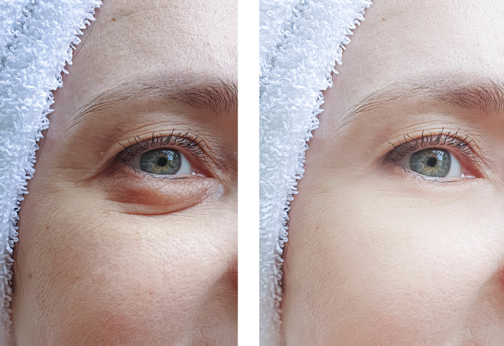 Eye bags and dark circles under eyes treatment: help reduce puffy eyes and  dark eyelids