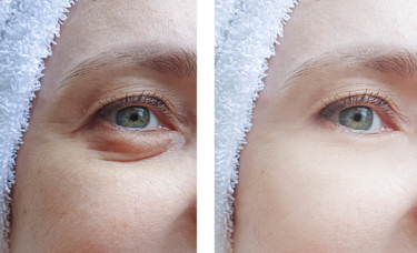 Woman with puffy bags under her eyes before and after images.