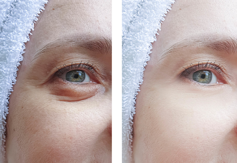 I paid $4K to remove my eye bags — people say I didn't need to