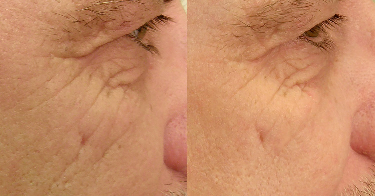 Before and after image of under-eye wrinkles treated with light therapy on an older white male.