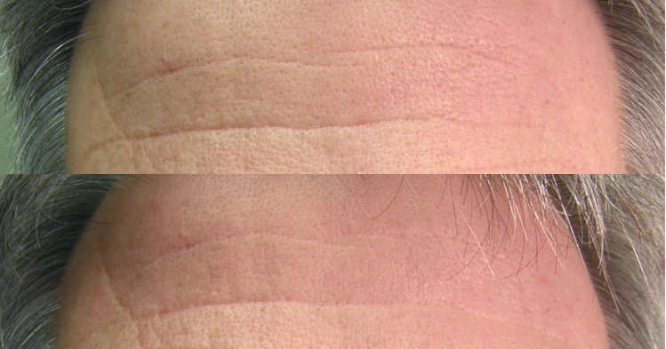 Before and after images of forehead wrinkles on an older white male treated with light therapy. 