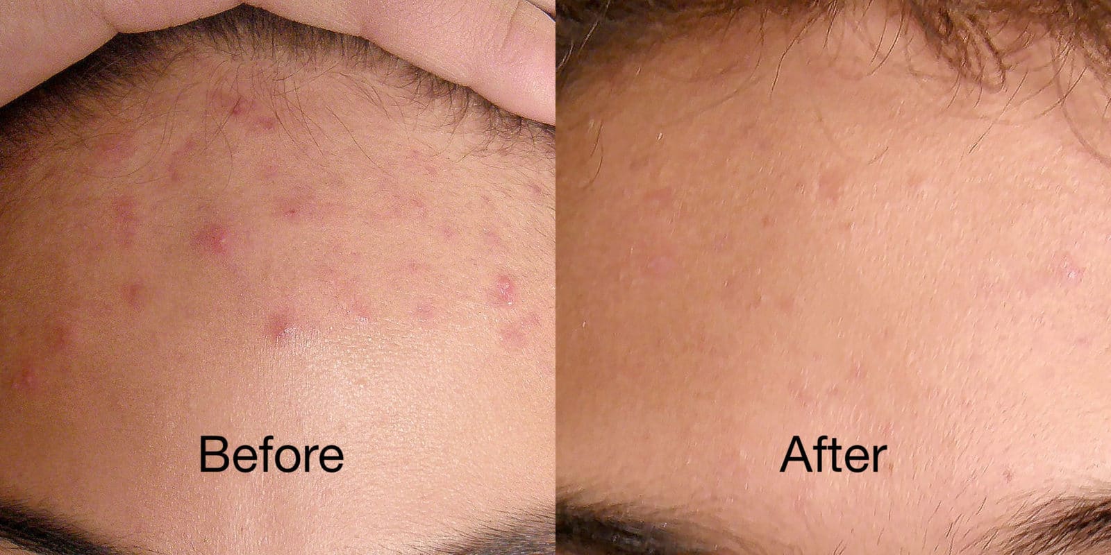 Before and after images of the forehead of a reVive Light Therapy acne device user showing a decrease in acne blemishes.
