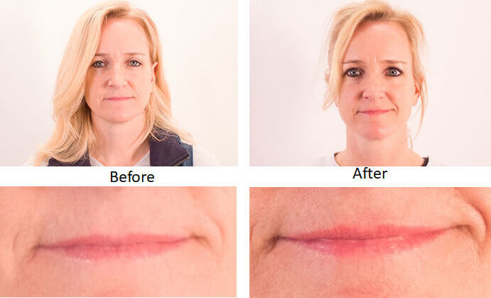 Before and after photos of an older woman who used light therapy for fuller lips.