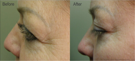 In house wrinkle reduction study before and after crows feet