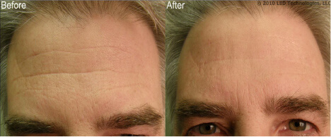In house wrinkle reduction study before and after fine lines on forehead