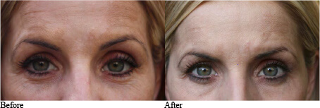 In house wrinkle reduction study before and after skin tone and discoloration