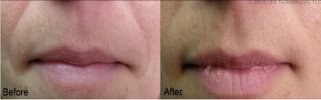 In house wrinkle reduction study before and after fine lines around mouth