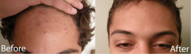 blue light therapy acne treatment study participant before and after reduction in blemishes on forehead