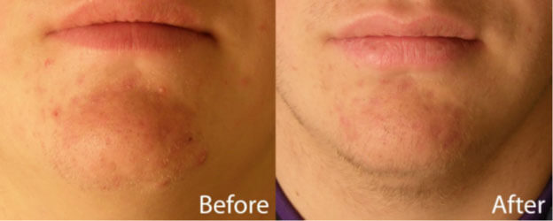 blue light therapy acne treatment study participant #2 before and after reduction in blemishes on chin