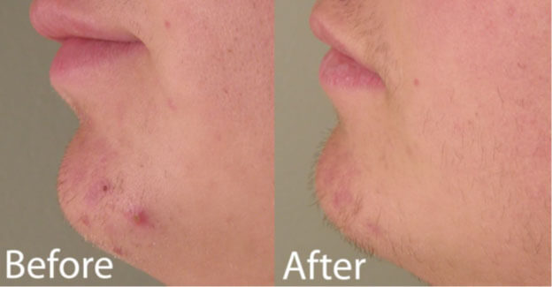 blue light therapy acne treatment study participant #3 before and after reduction in blemishes on chin