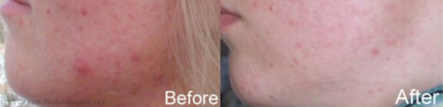 blue light therapy acne treatment study participant #4 before and after reduction in blemishes