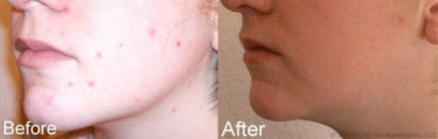 blue light therapy acne treatment study participant #6 before and after reduction in blemishes