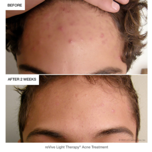 Acne-Generic-Before-After
