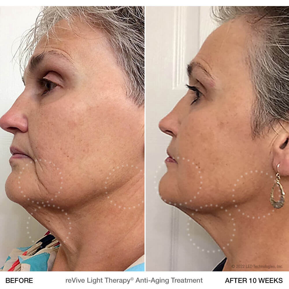 Before and After Photo of Clinical Anti-Aging treatment after 10 weeks of use