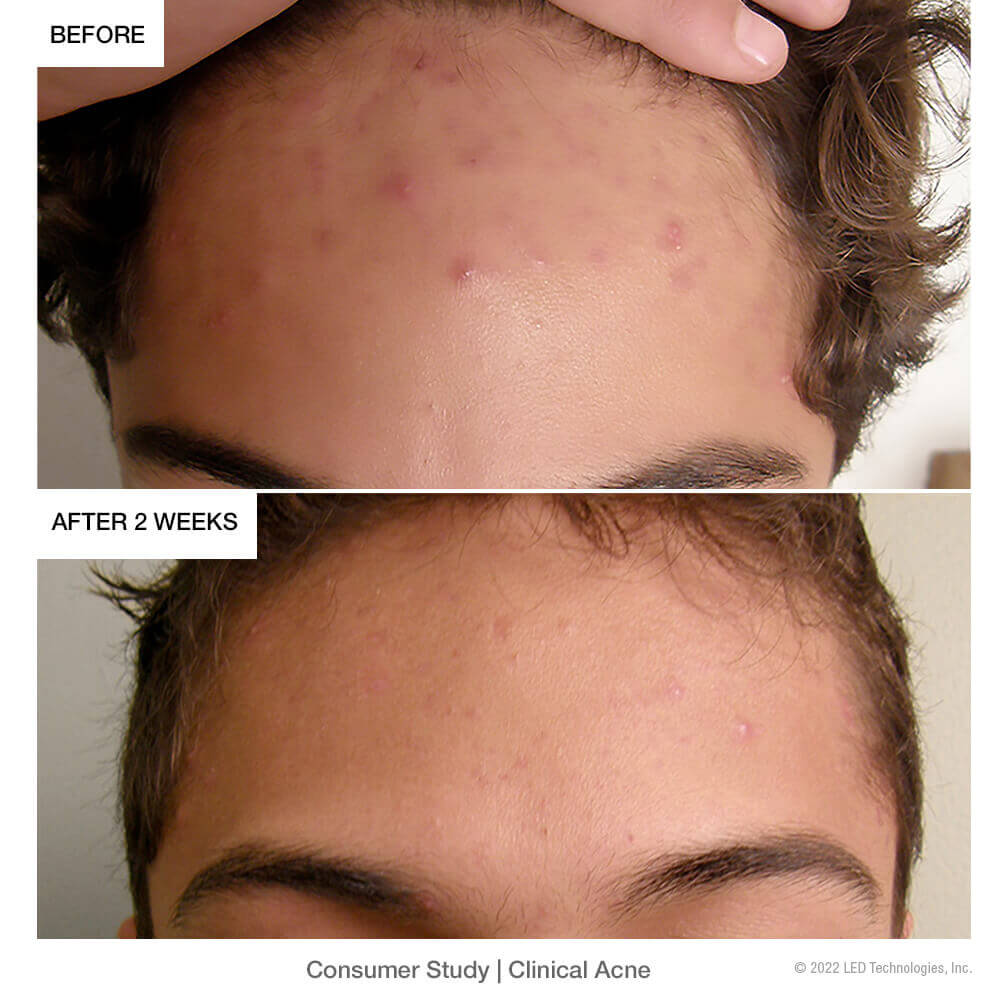 Clinical-Acne-Product-Page-Before-After Clinical-Acne-Product-Page-Before-After