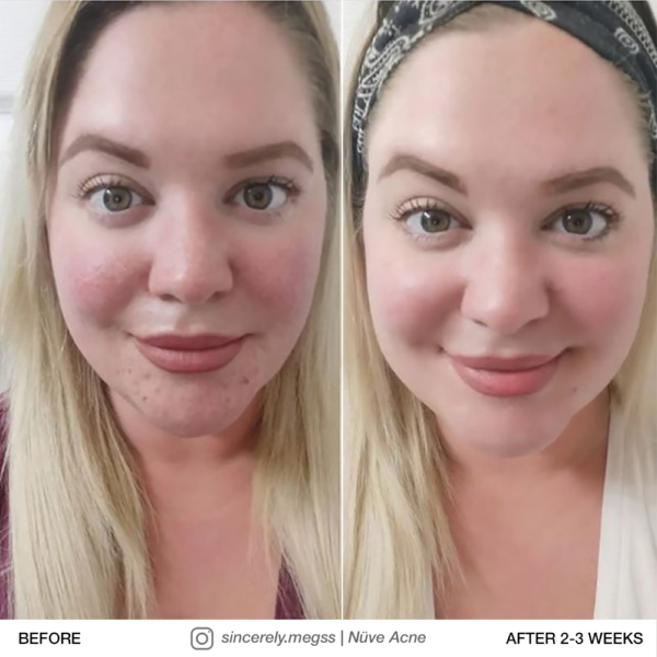 IG-SincerelyMegss-NuveAcne-Before-after-web