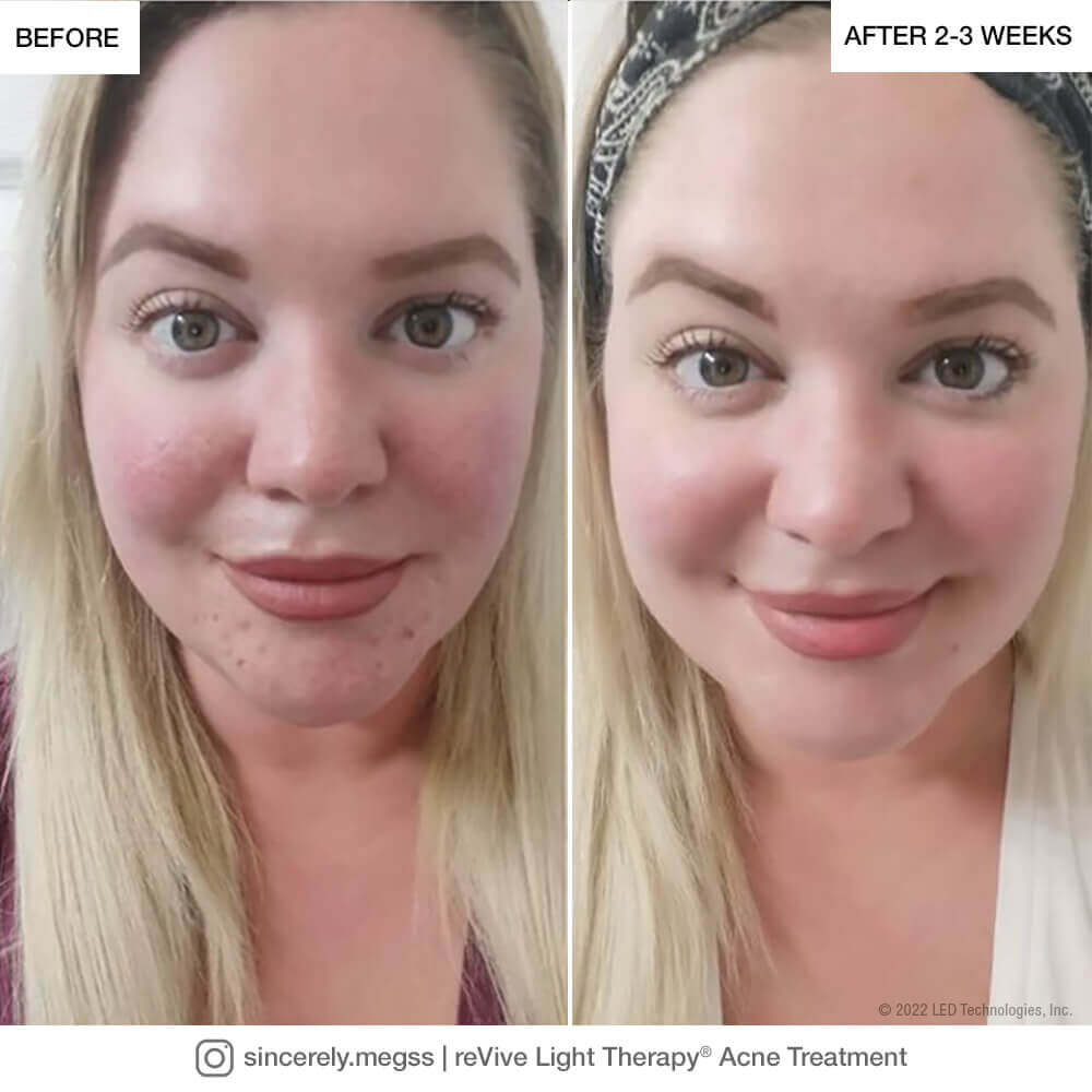 Megss-Acne-Before-After-web-1 Megss-Acne-Before-After-web-1