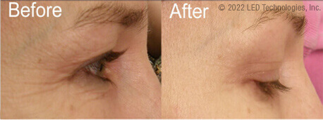 In house wrinkle reduction study before and after crows feet