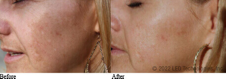 In house wrinkle reduction study before and after skin tone