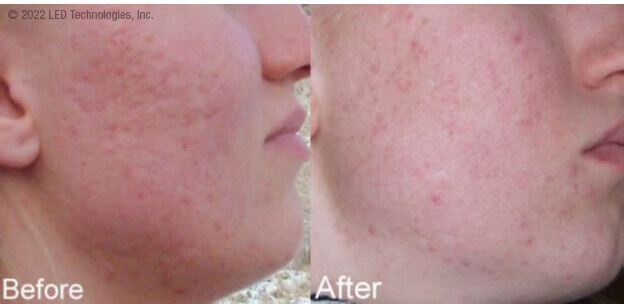 blue light therapy acne treatment study participant before and after reduction in acne and acne scarring on face