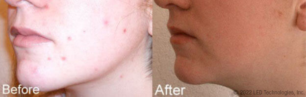 blue light therapy acne treatment study participant #6 before and after reduction in blemishes