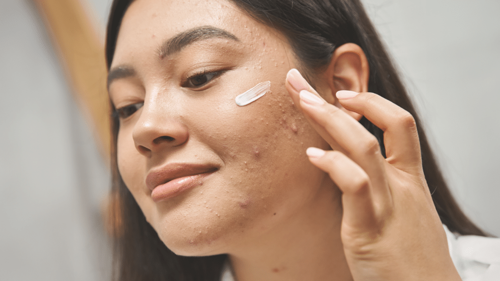 Young woman looking away from the camera applies white cream to cheekbone to help fight acne