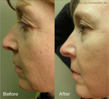 In house wrinkle reduction study before and after fine lines around mouth, jawline and eyes